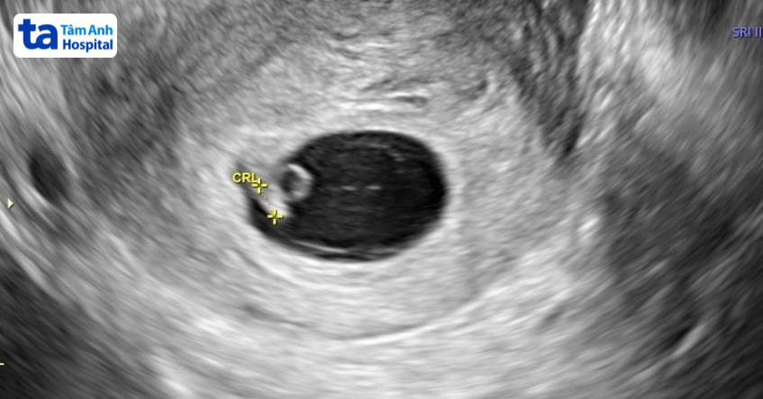 Hình ảnh siêu âm thai ở tuần tuổi thai thứ 6 (tương đương 4 tuần sau chuyển phôi)