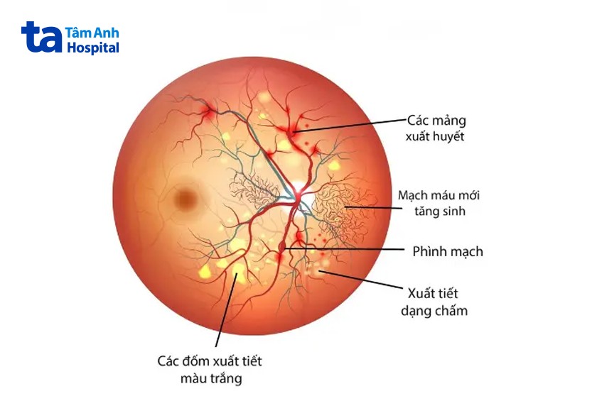 hình ảnh tăng sinh dịch kính võng mạc