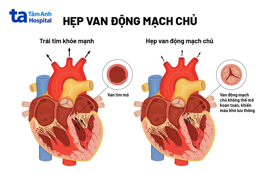 Hình ảnh trái tim bình thường và trái tim bị hẹp van động mạch chủ