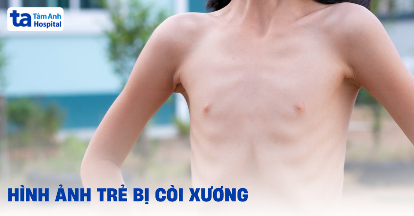 Hình ảnh trẻ bị còi xương cha mẹ cần nhận biết không nên chủ quan
