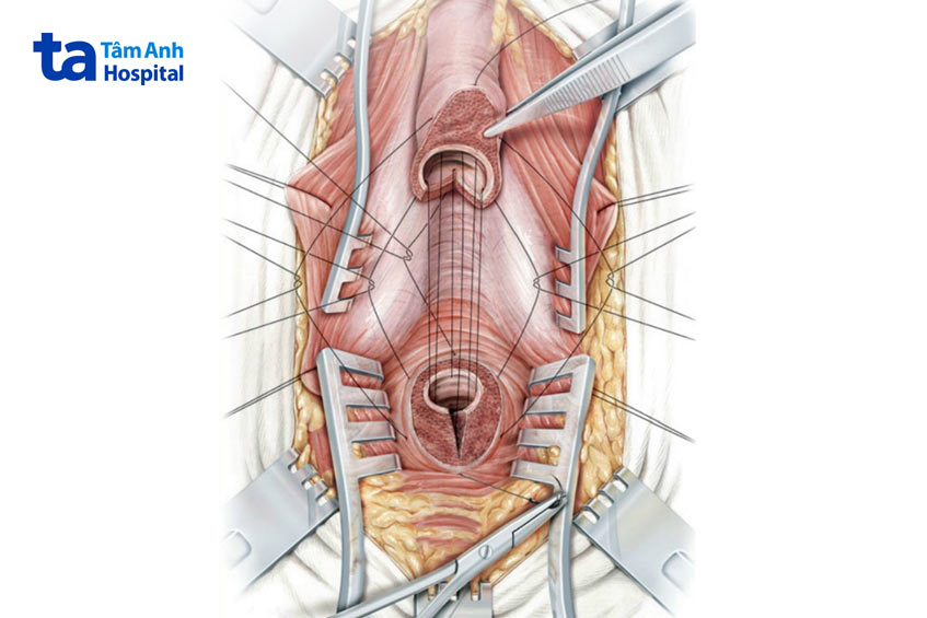 hình minh họa phẫu thuật tạo hình niệu đạo cắt nối tận tận
