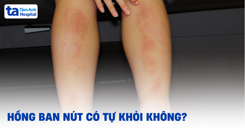 Hồng ban nút có tự khỏi không? Cần điều trị như thế nào?
