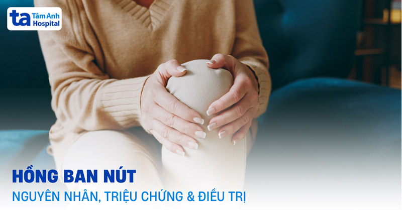 Hồng ban nút là bệnh gì?
