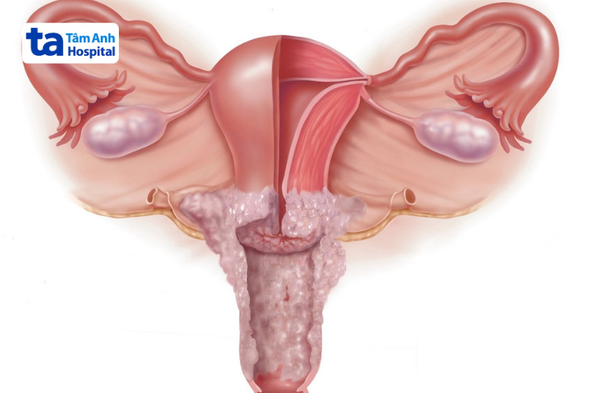 hpv type 16 và 18 gây ra khoảng 70% trường hợp ung thư cổ tử cung