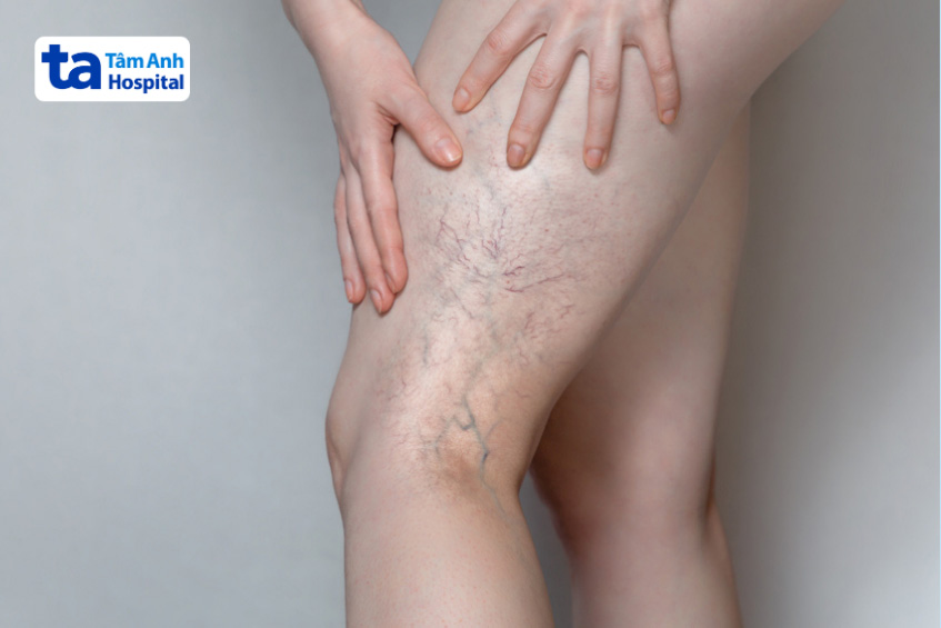 Huyết khối tĩnh mạch sâu thường xảy ra ở cẳng chân và đùi