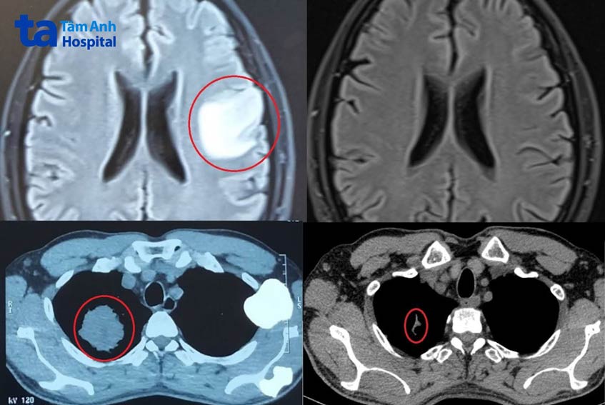 kết quả chụp cộng hưởng từ trước và sau điều trị