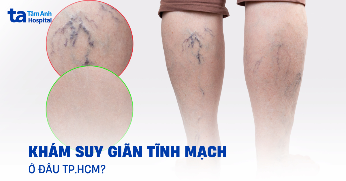 khám suy giãn tĩnh mạch ở đâu tphcm 