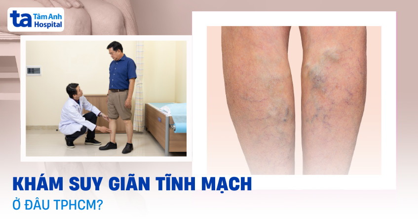 Khám suy giãn tĩnh mạch ở đâu TPHCM? Gợi ý địa chỉ chuyên môn cao