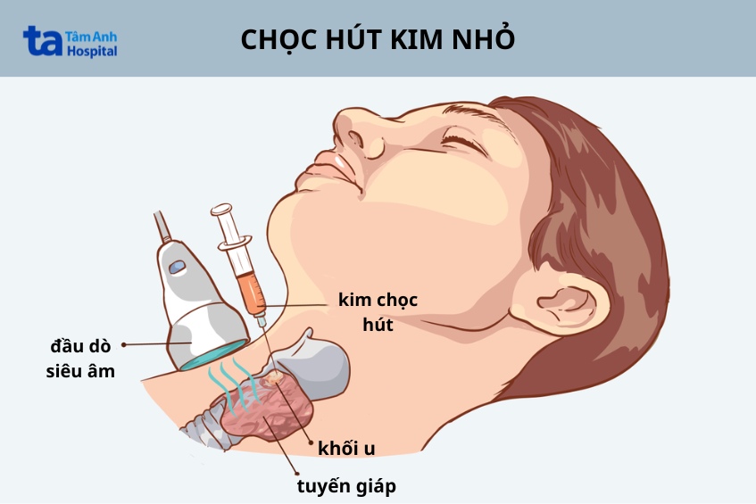 khám u tuyến giáp bằng chọc hút kim nhỏ