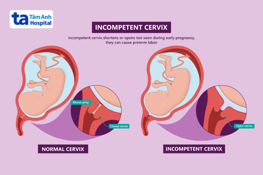 khâu đóng cổ tử cung bị hở