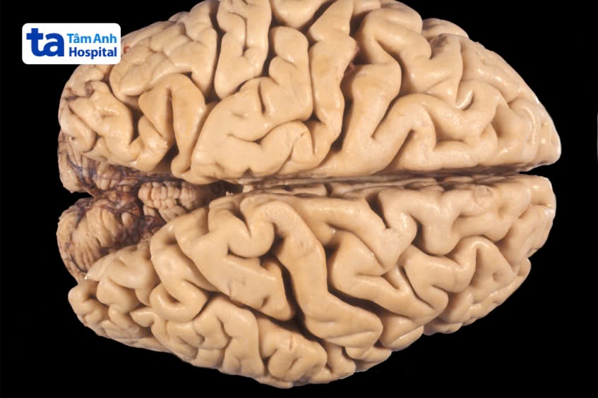khối lượng thể tích não giảm xuống do bệnh teo não
