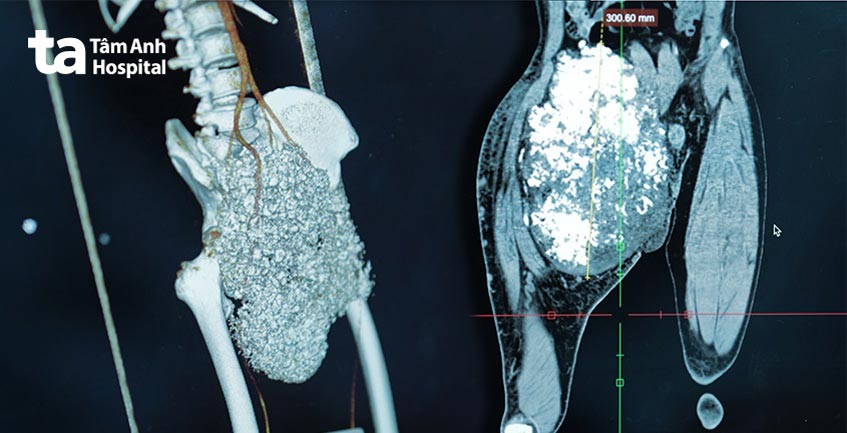 khối sarcoma ở vùng chậu