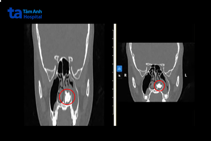khối sỏi ở mũi trái