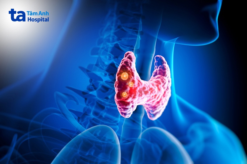 khối u tuyến giáp cần khám ngay