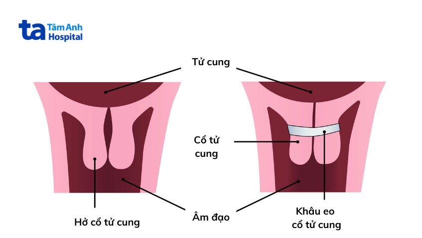 kỹ thuật giúp cổ tử cung đóng lại