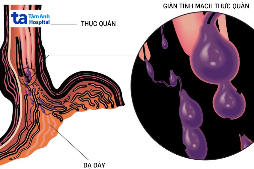 kỹ thuật thắt tĩnh mạch thực quản
