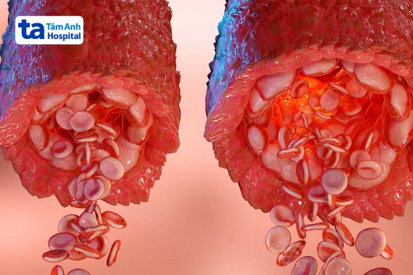 Mạch máu bình thường và mạch máu được giãn ra