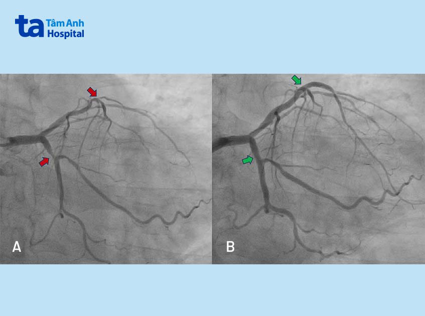 Mạch vành trái tắc hẹp nhiều đoạn (hình A) và sau khi được tái thông (hình B)