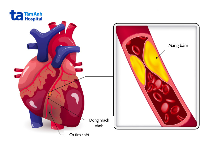 Các mảng xơ vữa trong lòng động mạch gây tắc nghẽn dòng máu đến tim