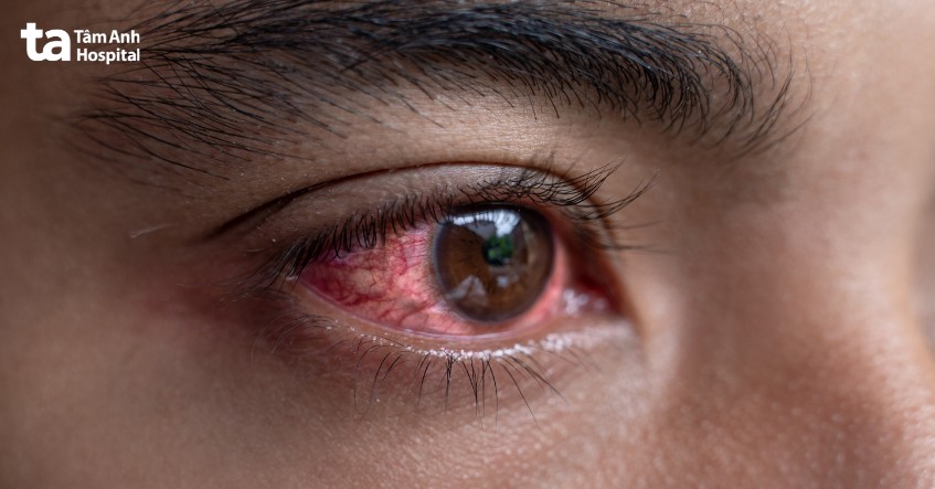 mắt đỏ là dấu hiệu cần khám mắt