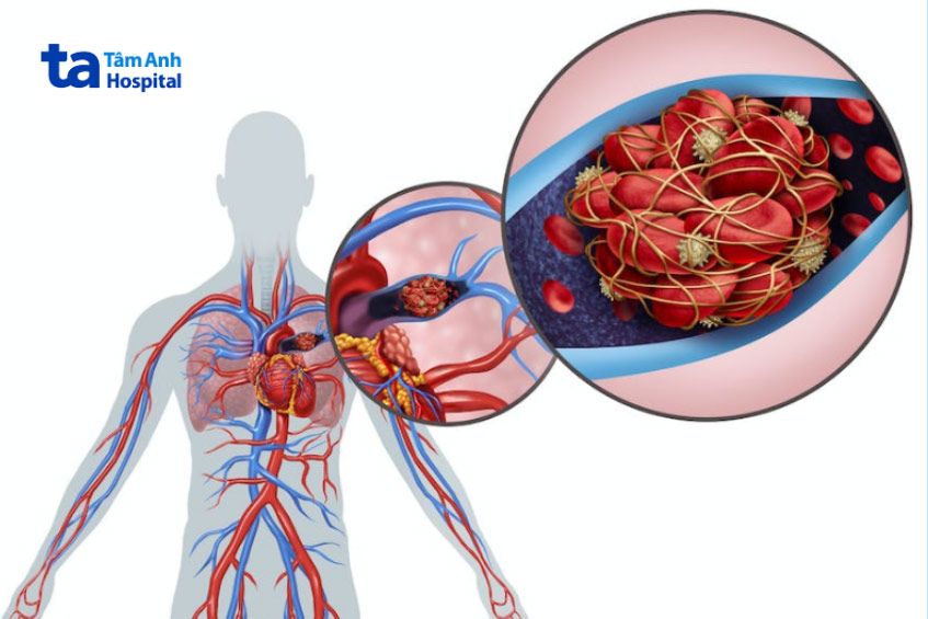 Máu đông di chuyển đến các mạch máu trong phổi gây thuyên tắc phổi