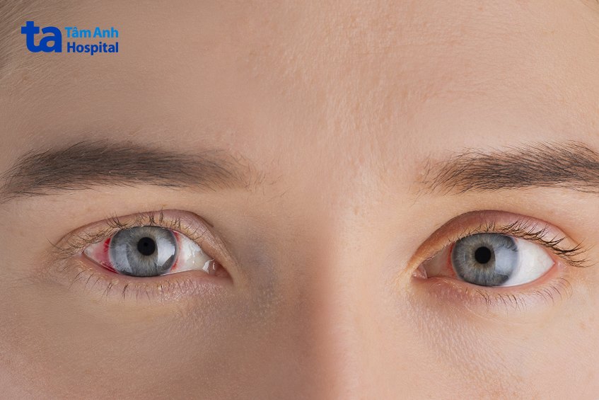 máu tràn vào buồng dịch kính