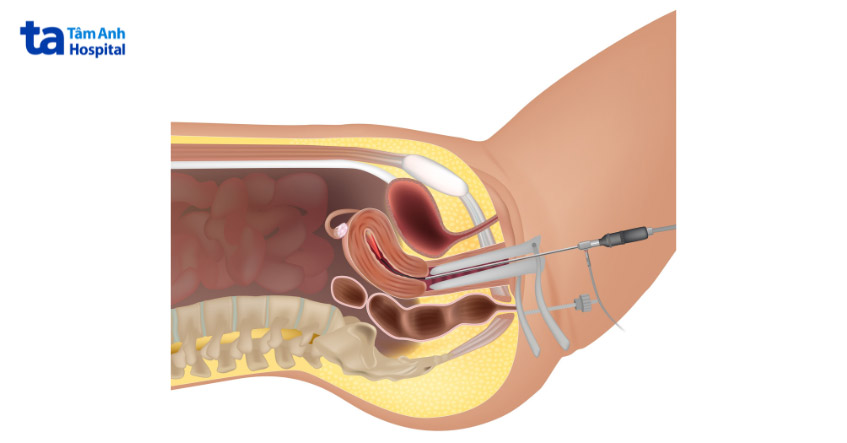 mổ nội soi thường được chỉ định trong điều trị