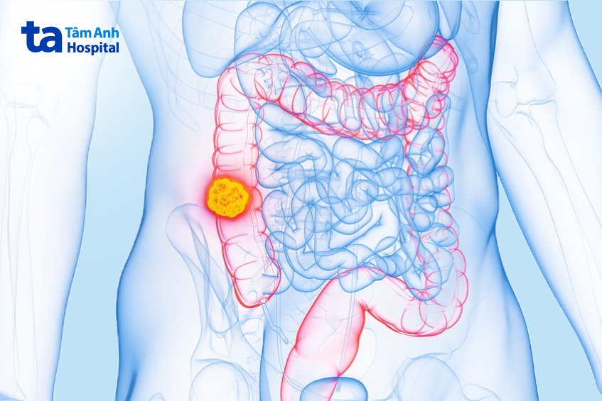 mô phỏng khối ung thư đại tràng cần khám ngay