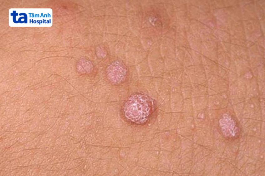 mụn cóc sinh dục ở người do hpv type 6