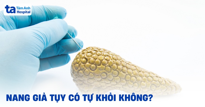 Nang giả tụy có tự khỏi không? Bệnh dứt điểm hoàn toàn không?