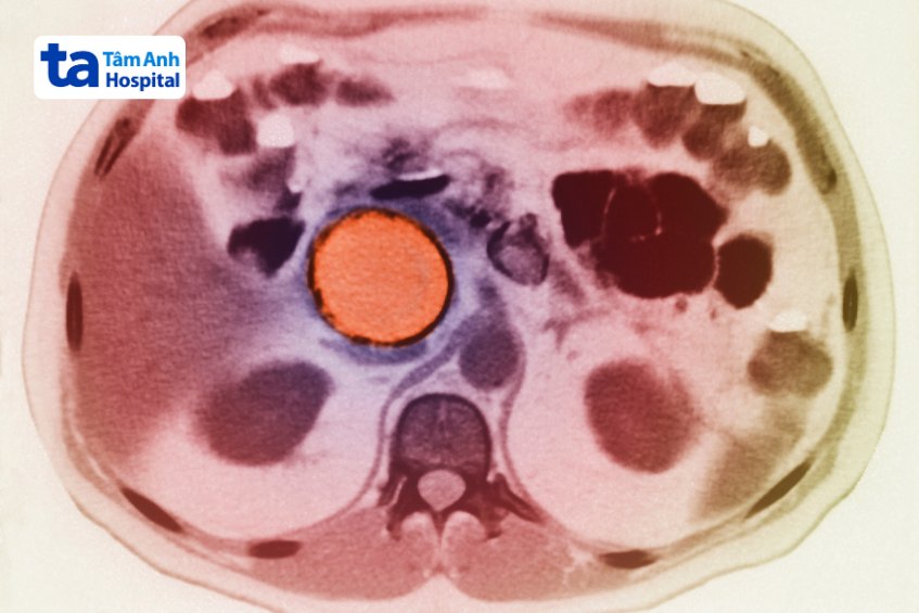 nang giả tụy khổng lồ