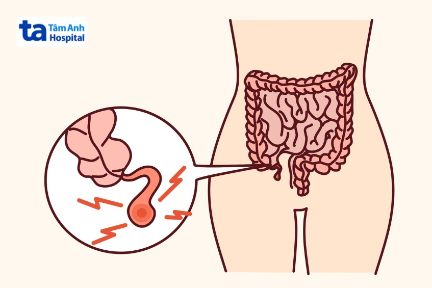 nguyên nhân phổ biến gây đau bụng dưới bên phải