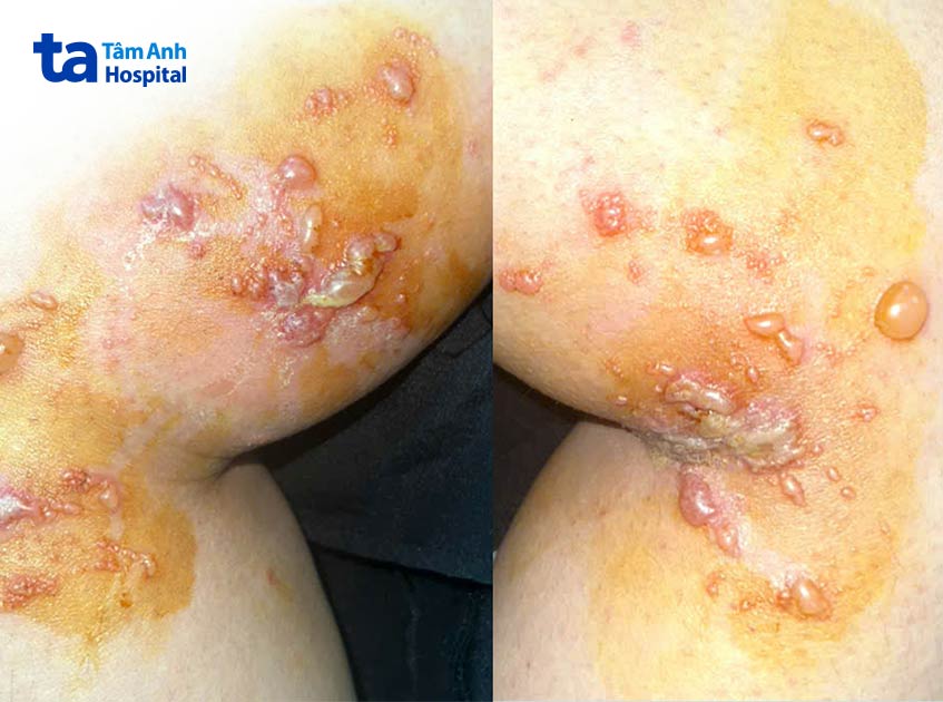 những vết phồng rộp ở hai chân