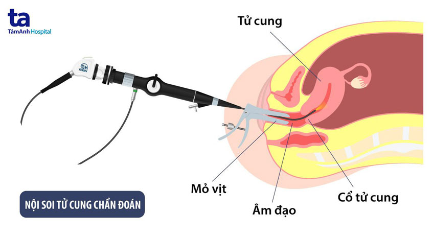 nội soi buồng tử cung
