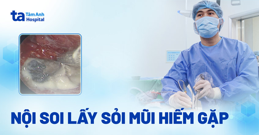 nội soi lấy sỏi mũi hiếm gặp