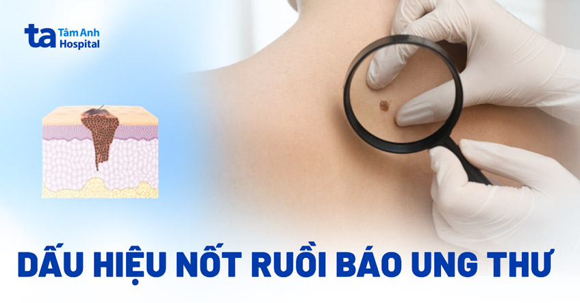 Dấu hiệu nốt ruồi báo ung thư dễ nhận biết (kèm hình ảnh)