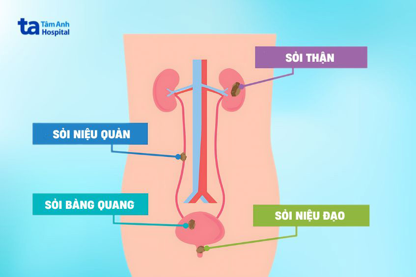 phân loại sỏi tiết niệu theo vị trí