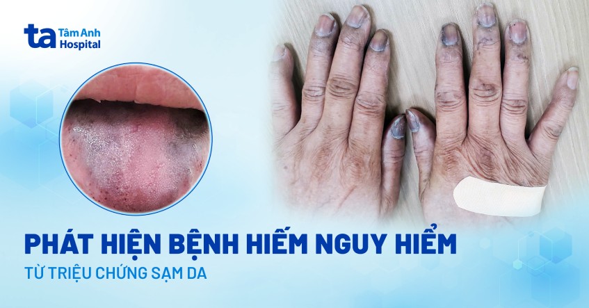 Phát hiện bệnh hiếm nguy hiểm từ triệu chứng sạm da