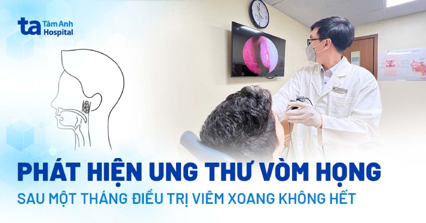 phát hiện ung thư vòm họng sau 1 tháng viêm xoang