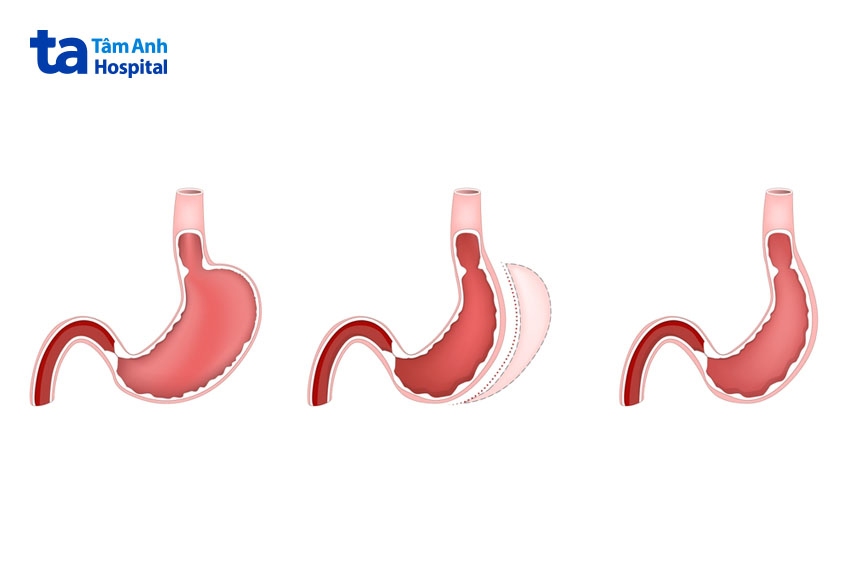 Phẫu thuật cắt dạ dày hình ống VSG