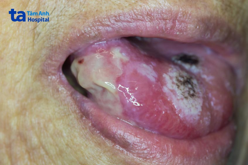 phẫu thuật lưỡi là phương pháp điều trị chủ yếu