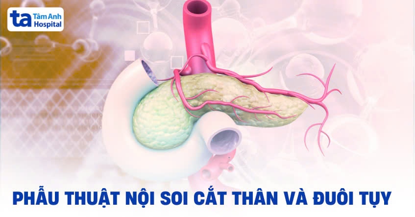 Phẫu thuật nội soi cắt thân và đuôi tụy: Quy trình thực hiện