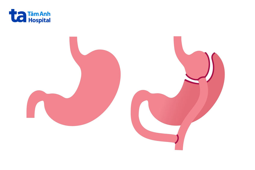 Phẫu thuật nối tắt dạ dày là một trong các phương pháp phẫu thuật