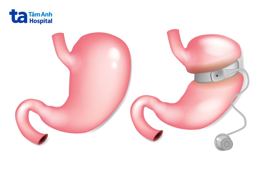 Phẫu thuật thắt đai dạ dày có nhiều ưu điểm