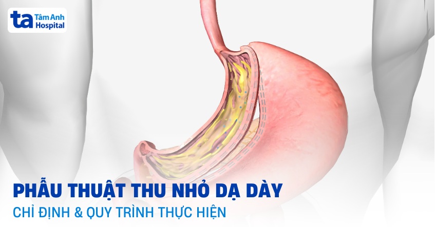 Phẫu thuật thu nhỏ dạ dày: Đối tượng và quy trình thực hiện