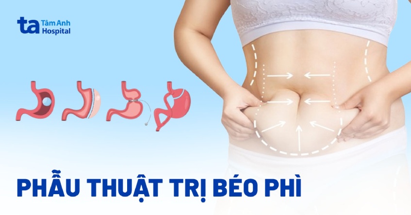 4 phẫu thuật trị béo phì phổ biến: Hiệu quả ra sao? Cần lưu ý gì?