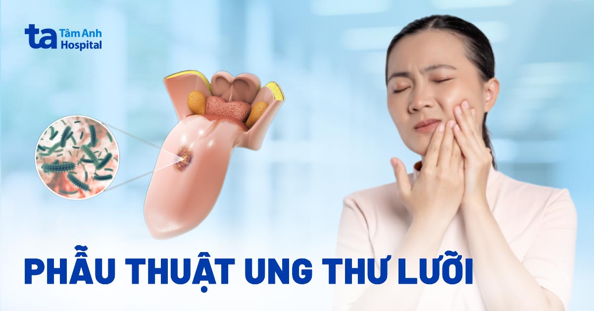 Chi phí phẫu thuật ung thư lưỡi bao nhiêu? Nên thực hiện không?