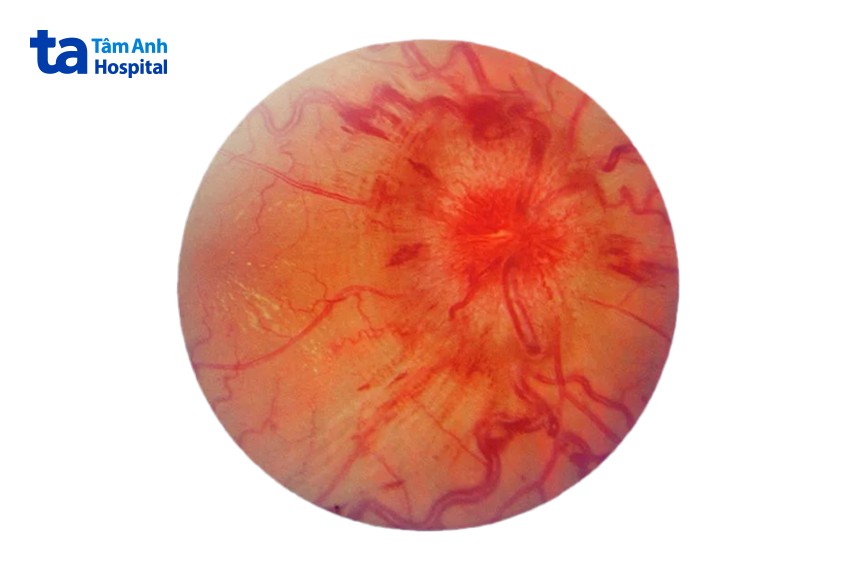 phù gai thị làm giảm thị lực
