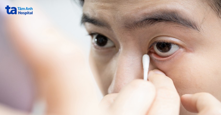 quặm mi khiến lông mi cọ vào mắt