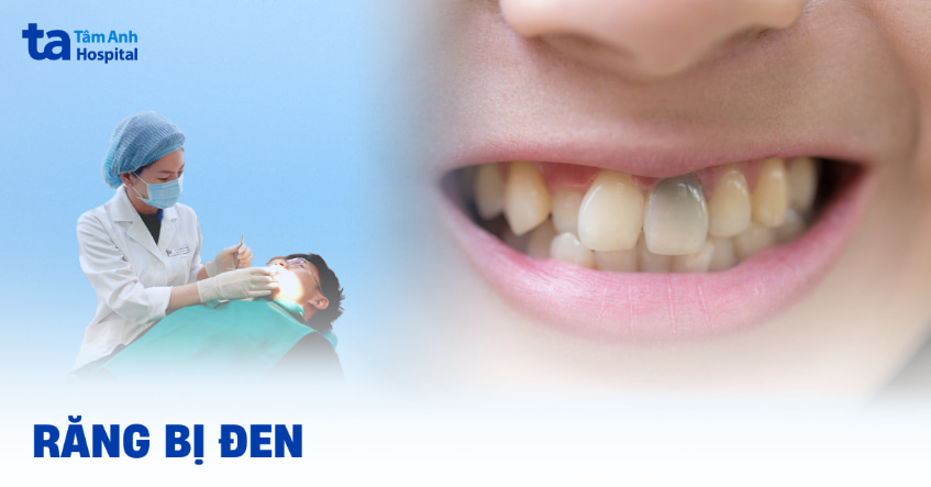 Răng bị đen: Nguyên nhân tại sao, cách điều trị và phòng ngừa